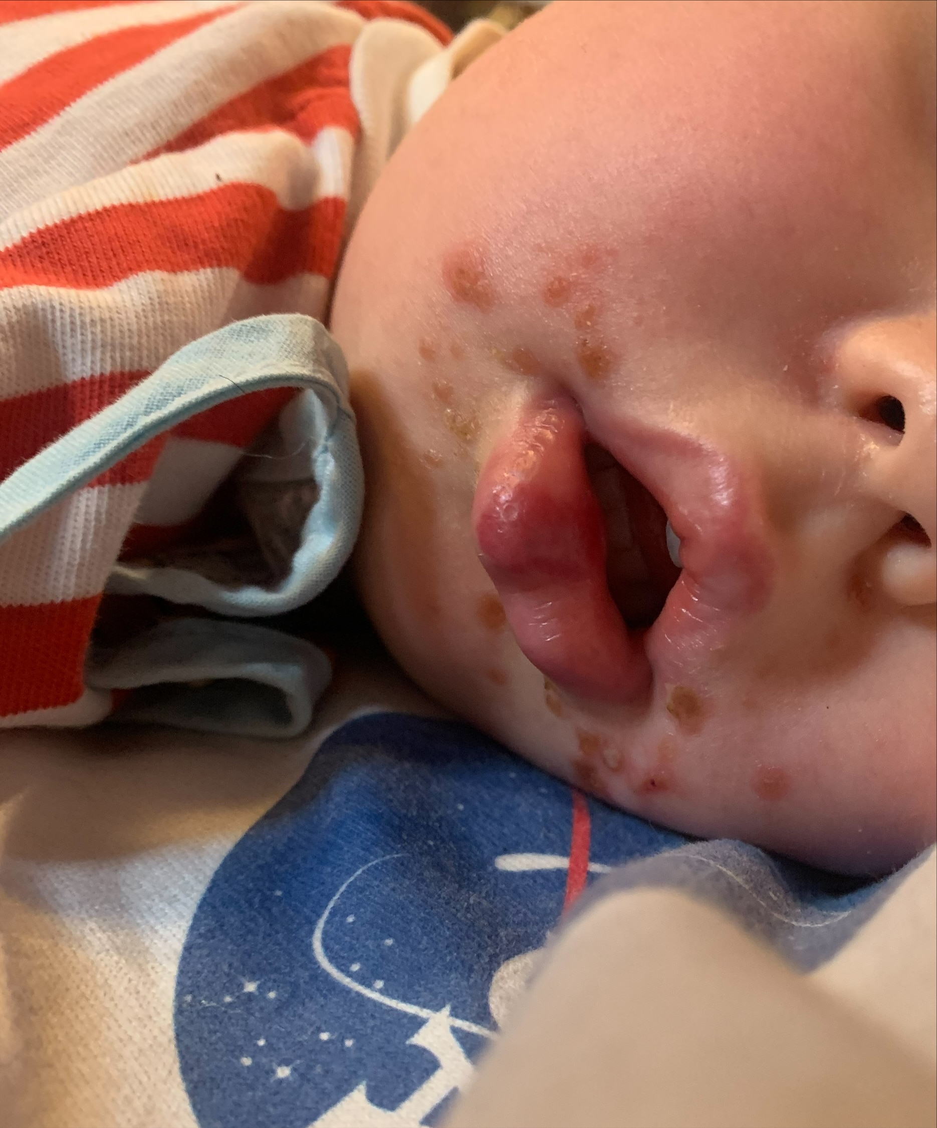 hand-foot-mouth-disease-child-stage1.jpg hand-foot-mouth-disease-child-stage1.jpg